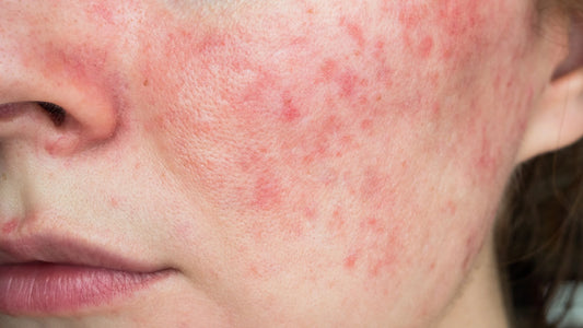 Miel et rougeurs du visage : conseils pour une peau enfin apaisée